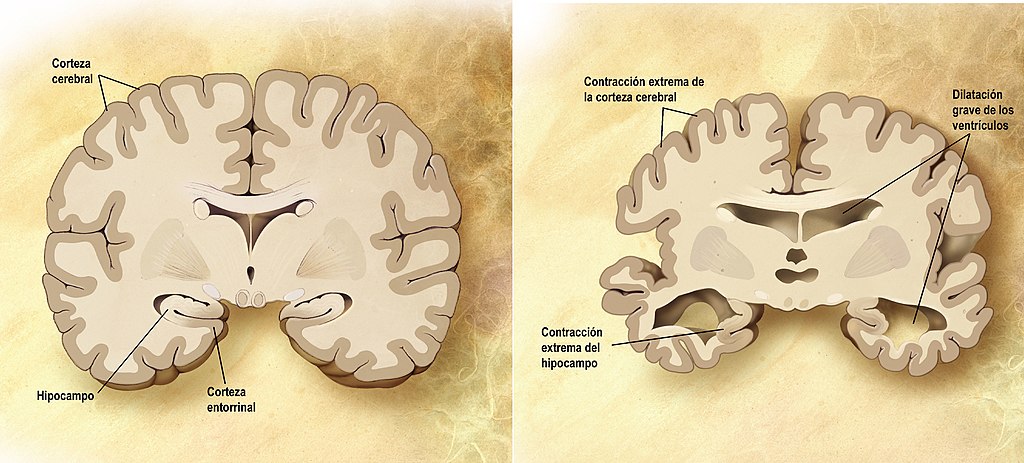 Corte frontal cerebral